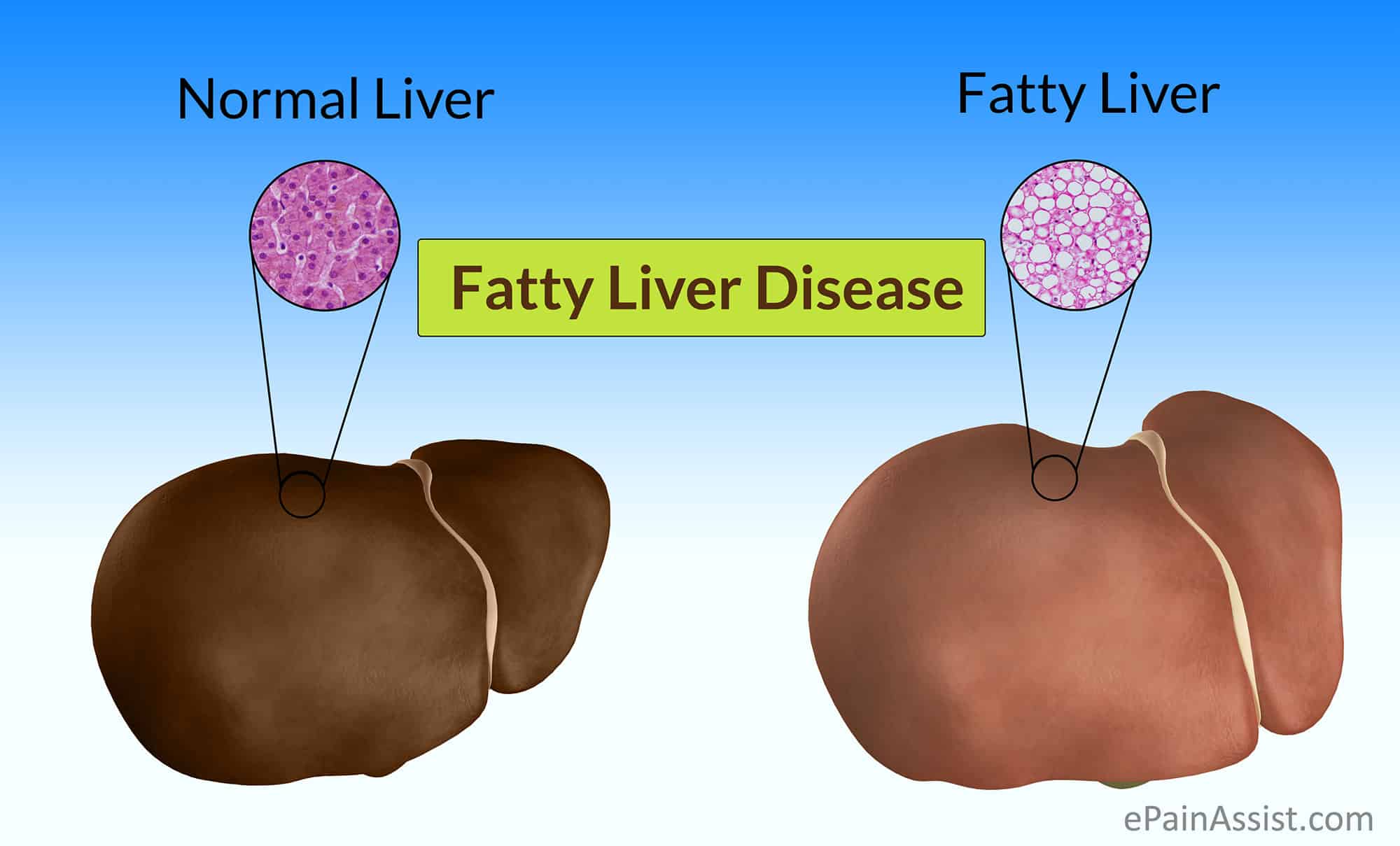 כבד שומני (FL - Fatty Liver) היא מחלה הנגרמת עקב הצטברות של שומן בתאי הכבד מעל הרמה המומלצת